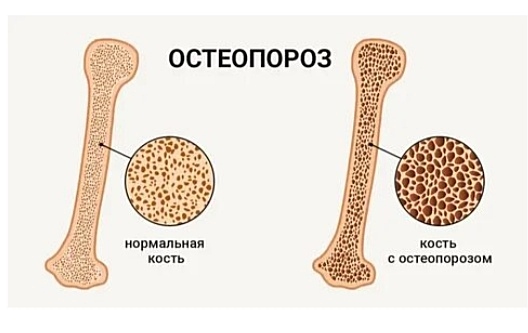 Всемирный день борьбы с остеопорозом